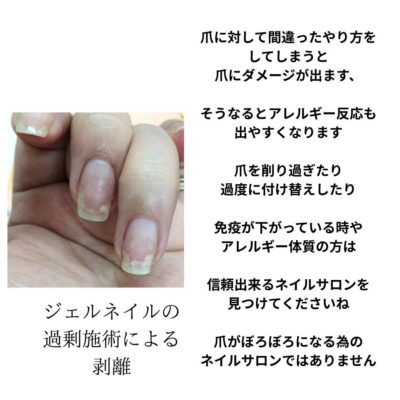 剥離した爪