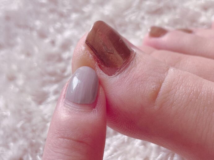 足の爪が巻き爪になっている様子